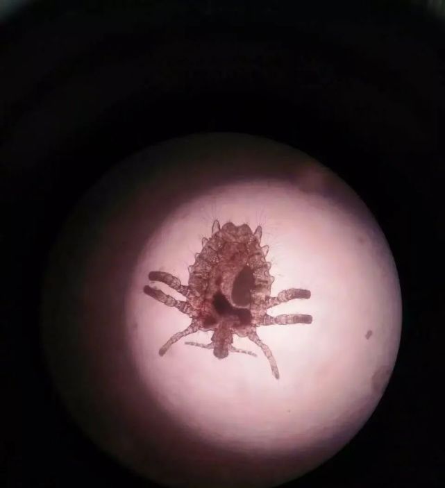 宝宝头上有虫子,原因竟是父母不检点!