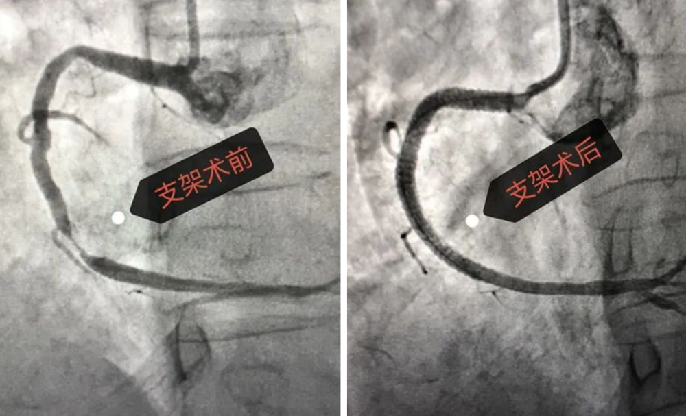 "急性心肌梗死是冠状动脉急性,持续性缺血缺氧所引起的心肌坏死.