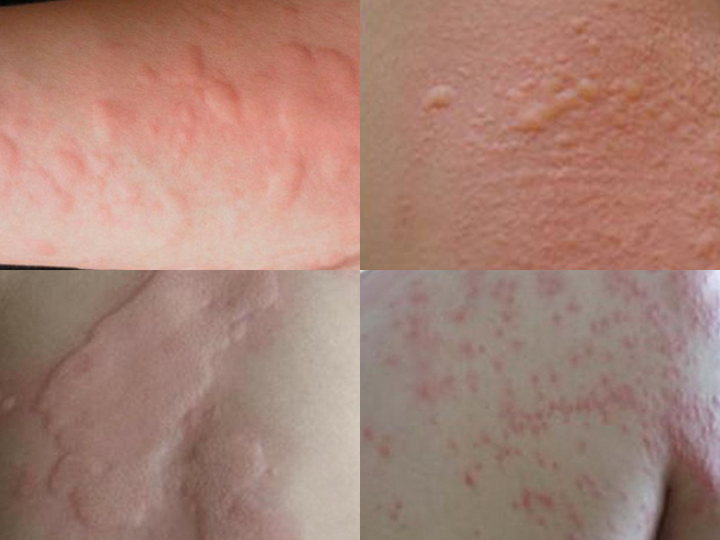 一般急性荨麻疹水肿可在数分钟至数小时内减轻,风团变为红斑并慢慢