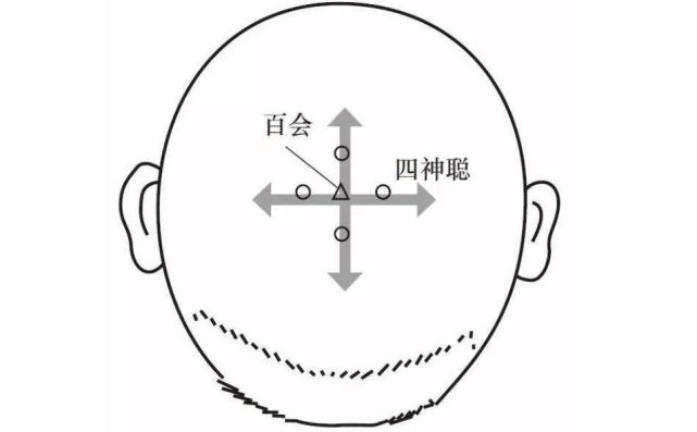 百会治百病,百会四神聪,灵犀一点通|百会穴|四神聪|中医