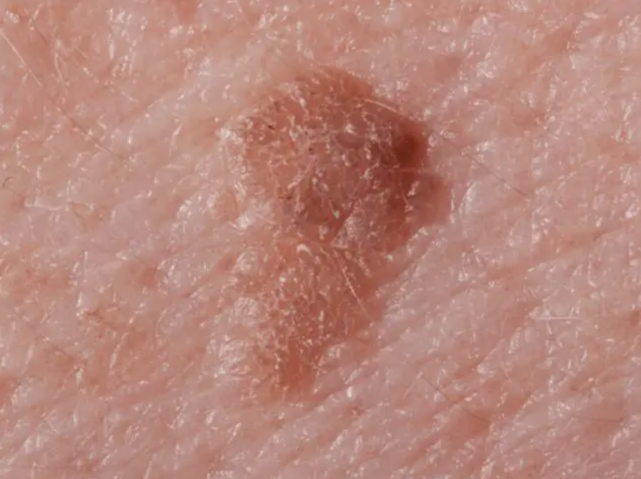 所谓疣体,其实就是由于感染hpv之后,导致的一种皮肤上的赘生物,起初
