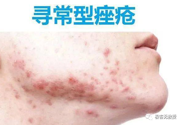 芳香疗法协同作用方程式:以女性痤疮患者案例实践为例【极客无教授】