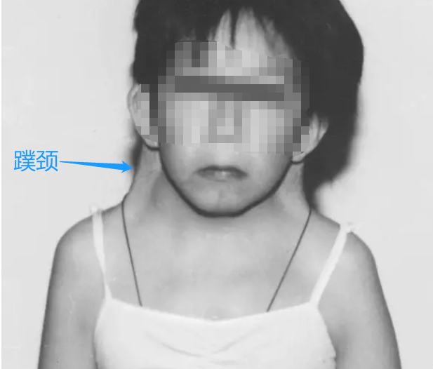 turner综合征外观基因检测结果分为三种类型:x单体型的"45,x"嵌合型的
