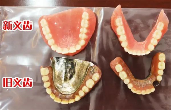 无挂钩活动假牙怎么镶好后悔没看成效图片和优缺点附价格