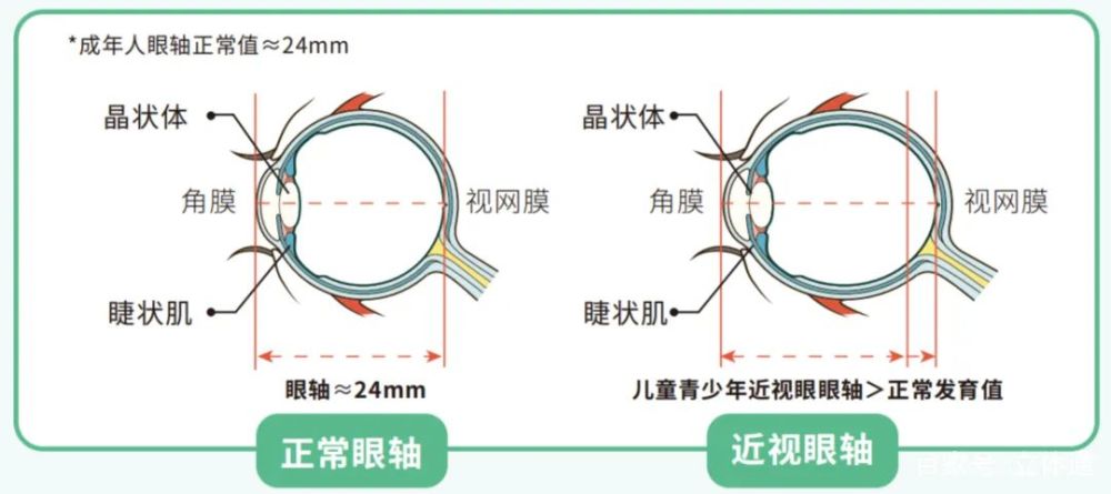 近视防控必读眼轴到底是什么