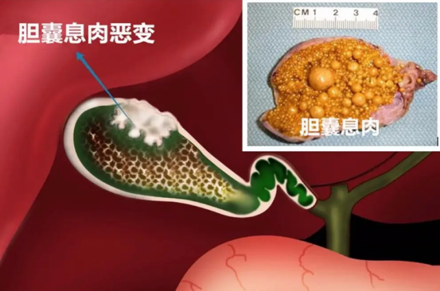 胆囊息肉样病变是什么意思?生长速度快,想切除有什么影响?