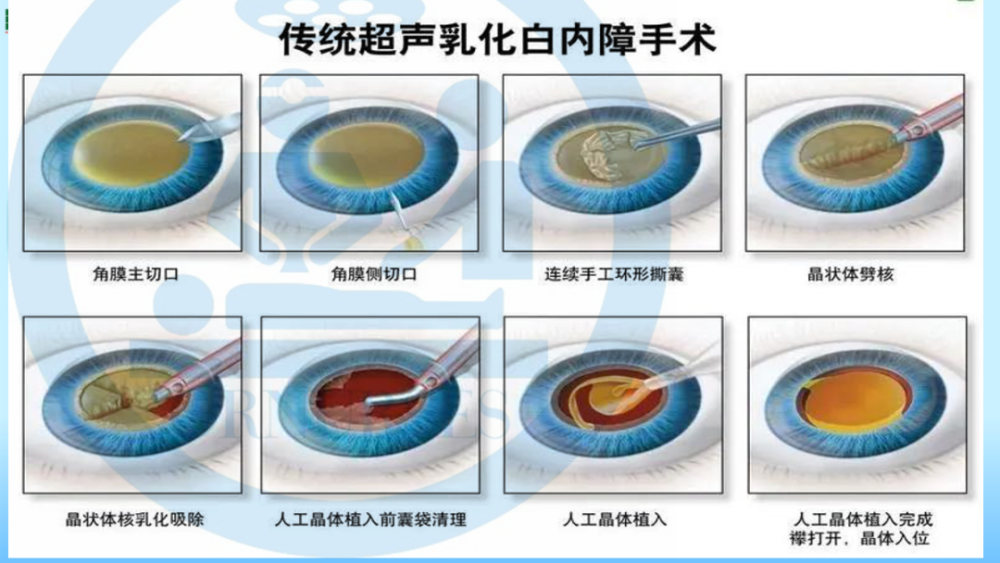 图文课件白内障超声乳化摘除人工晶体植入术护理查房