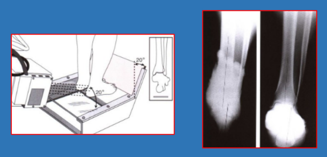 骨科精读|图文结合:足踝部常见x线测量技巧,赶紧收藏!