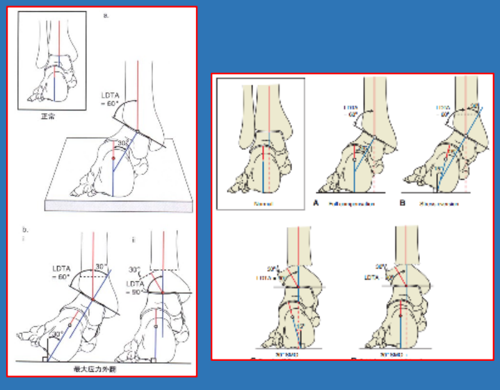 骨科精读图文结合足踝部常见x线测量技巧赶紧收藏