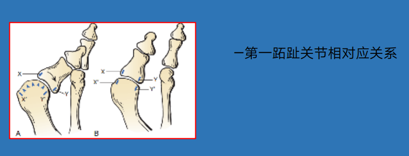 前足—拇趾跖趾间角第一跖骨与踇趾近节趾骨轴线夹角,正常:18°意义