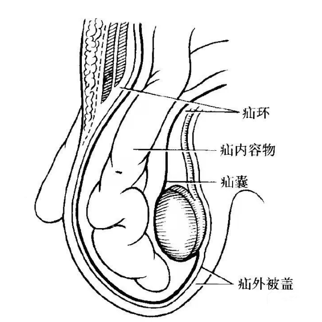 疝气手术治疗费用多少钱,医保可以报销吗?