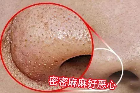 变态"黑头吸尘器,不伤毛孔超舒适,几毛钱搞定万年黑头!
