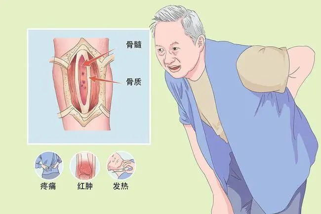 69岁老太患附骨疽小腿创面3年不愈中西医结合治疗骨科顽疾