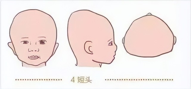 所以还是要记住:如果宝宝没有长时间习惯性仰睡,但出现了扁头,或者