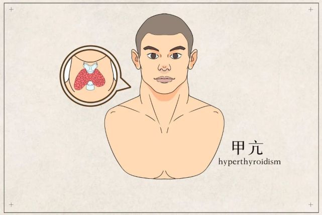 这六种常见甲状腺疾病一定要知道!定期体检才能早发现早治疗