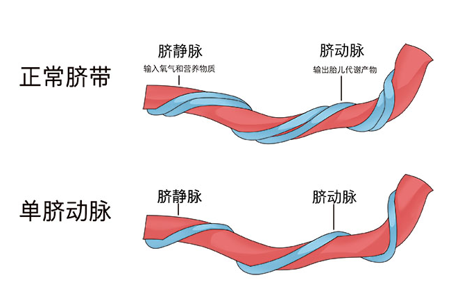 检查发现宝宝只有一条脐动脉还能不能好好发育了