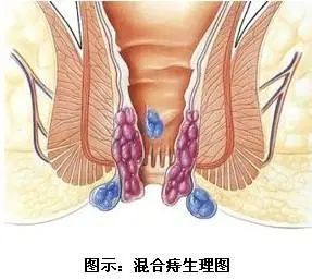 肛门坠痛 排便不尽:肛窦炎具体症状:始为肛门坠胀不适,慢慢发展伴发