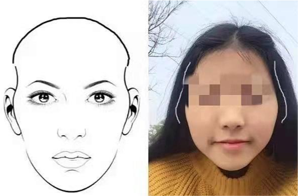 ,颞部凹陷会显得颧弓突出,影响脸形上半部分的轮廓,给人一种头小脸大