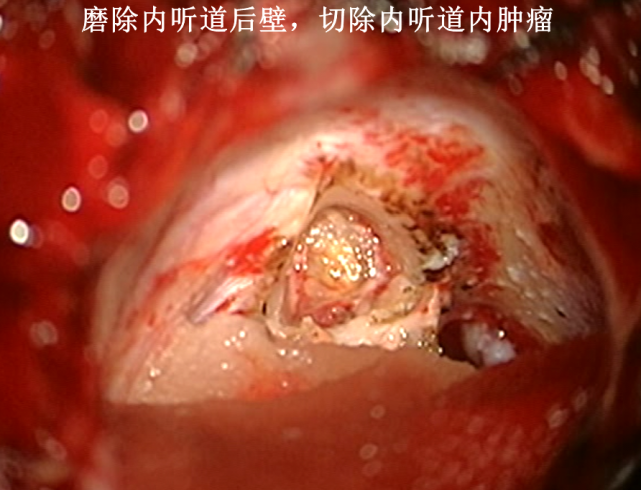 前庭神经鞘瘤表面膜性结构的正确分离对保护"面-听"功能的意义