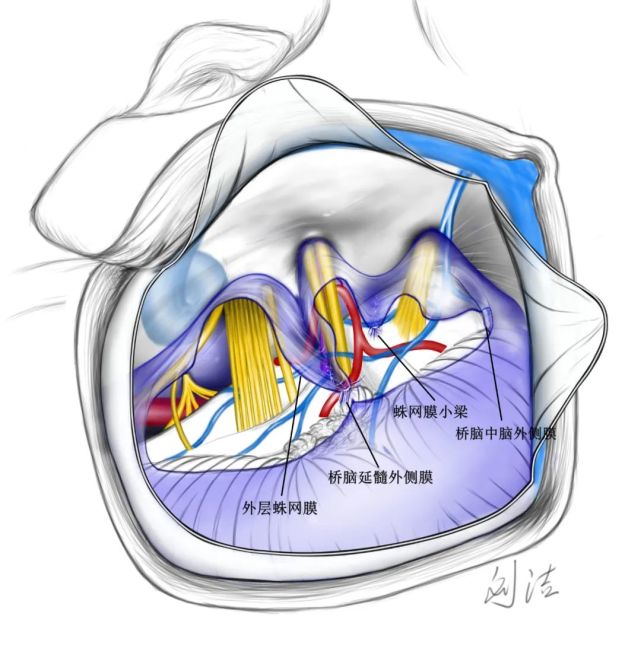 桥脑延髓外侧膜和桥脑中脑外侧膜之间的蛛网膜小梁将桥脑小脑池进一步