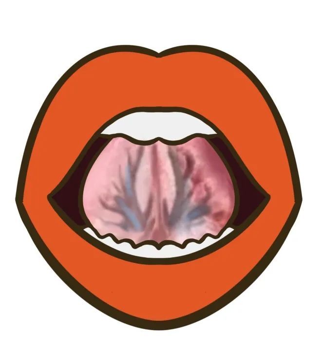 【舌象辨识】没有舌苔,舌头呈现暗红色或紫红色,舌边,舌尖有黑色淤点