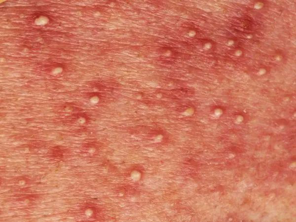 热疹的特点是一般长在出汗多的部位,比如头皮,前额,颈部,胸部,背部.