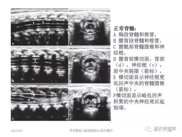 胎儿脊柱与脊髓圆锥