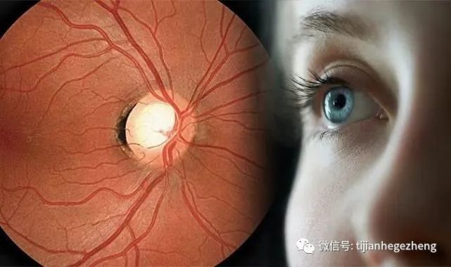 现役飞行员发现高眼压症会被停飞吗?