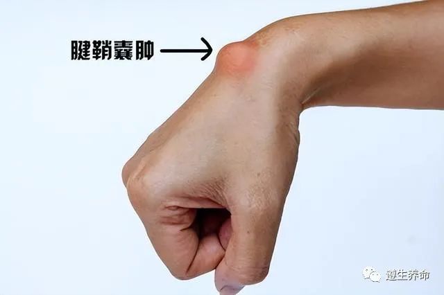 腱鞘囊肿是手部较为常见的软组织性肿瘤,最常发生于指间关节处的末端