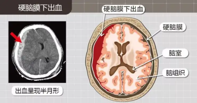 【医疗动态】头部外伤别大意,及时就医要牢记!