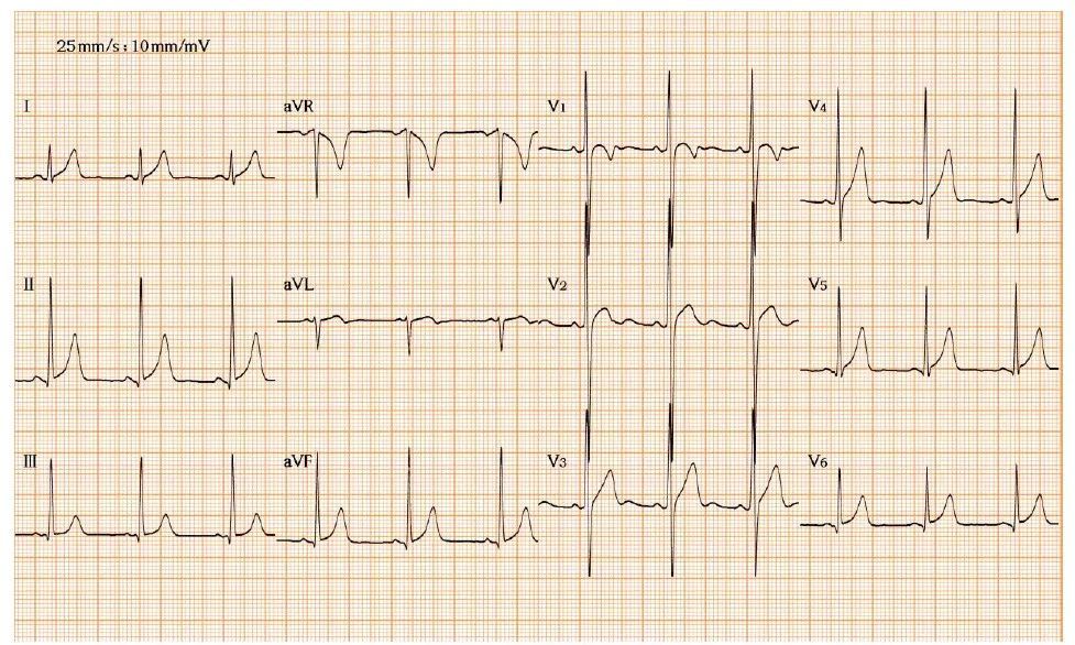 心电系列第二讲正常变异心电图