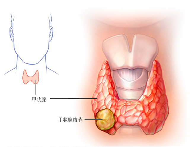 甲状腺是位于脖子底部,喉咙下方,一个很小的蝴蝶形腺体.