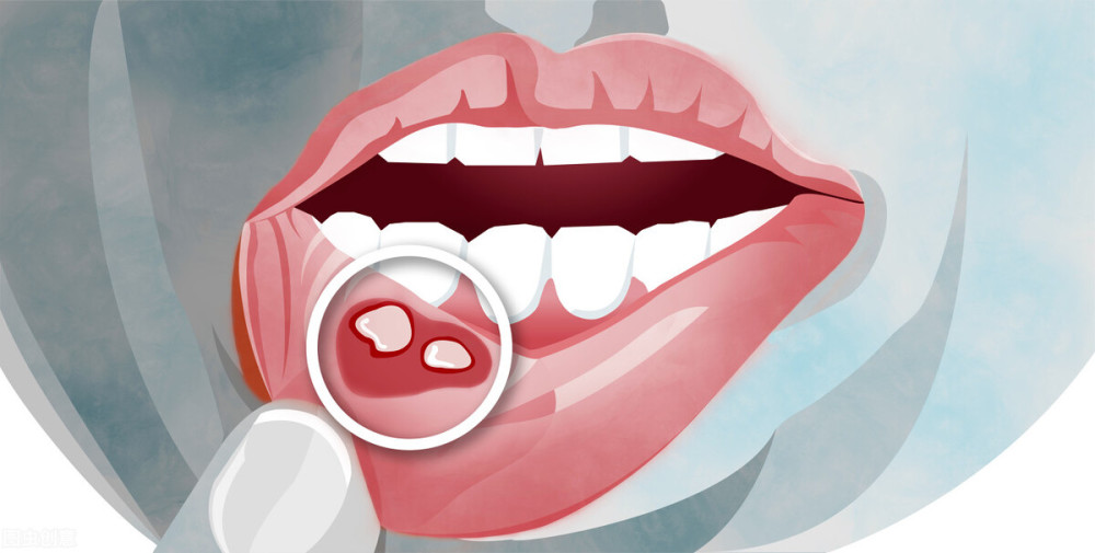 体内有癌嘴知道医生提醒口腔出现4种迹象可能是癌症来临