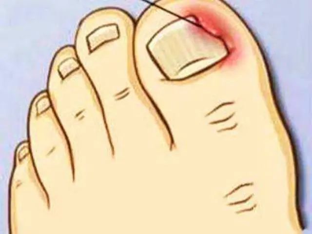 脚趾甲总往肉里钻一碰还疼教你小妙招缓解病灶告别疼痛