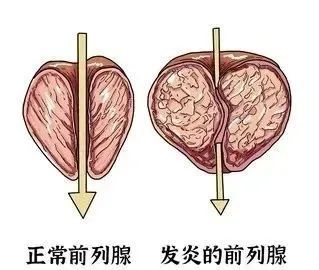 腺炎的三大特性|前列腺|干细胞疗法|干细胞|细胞|慢性前列腺炎|炎症