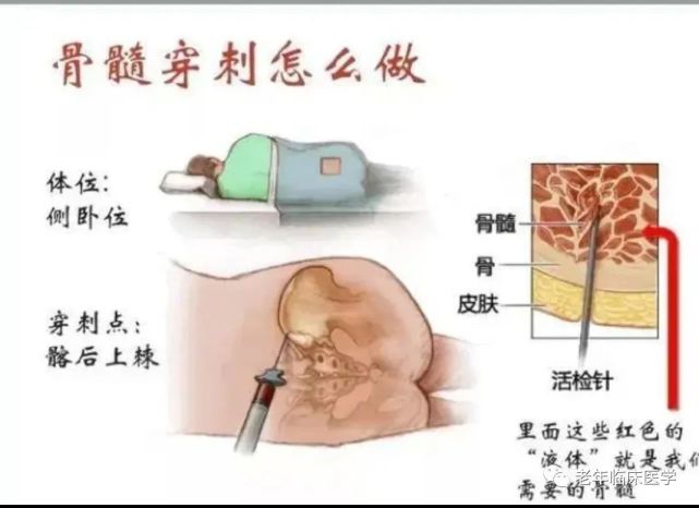 骨髓穿刺术