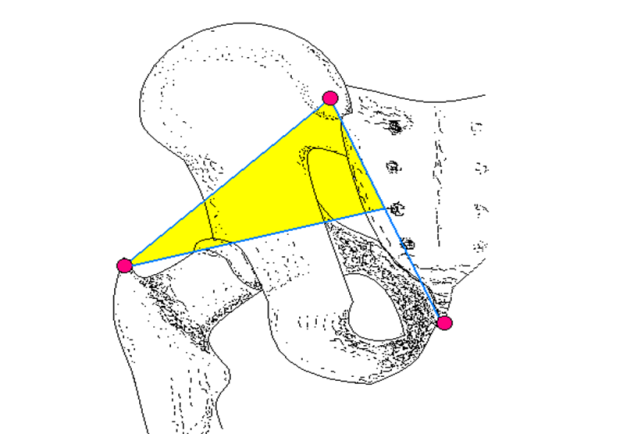 为梨状肌上缘;上下缘区域内即为梨状肌体表投影