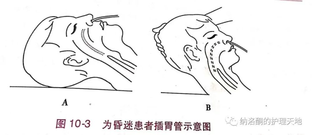 昏迷患者颈项强直不好插胃管怎么办教你4种不抬头插管法