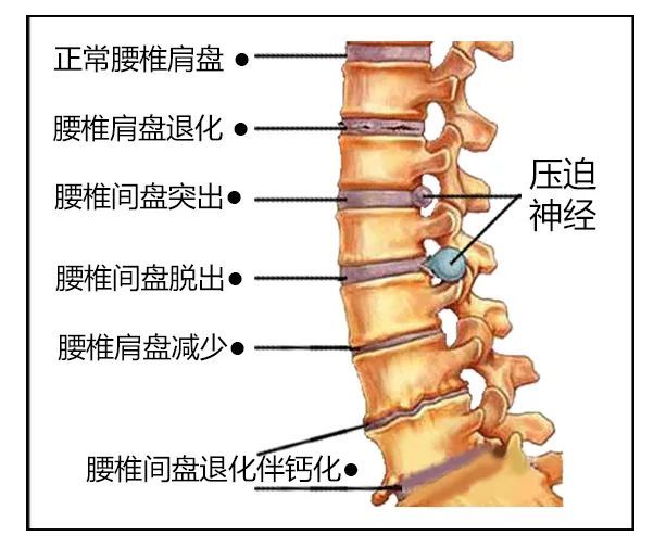 腰椎间盘突出?这里有你想看的