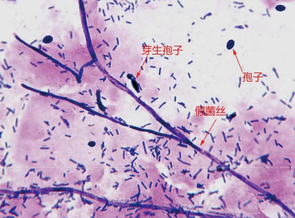 5,可能为单纯假丝酵母菌感染,若ph>4.5可能存在混合感染,尤其是合