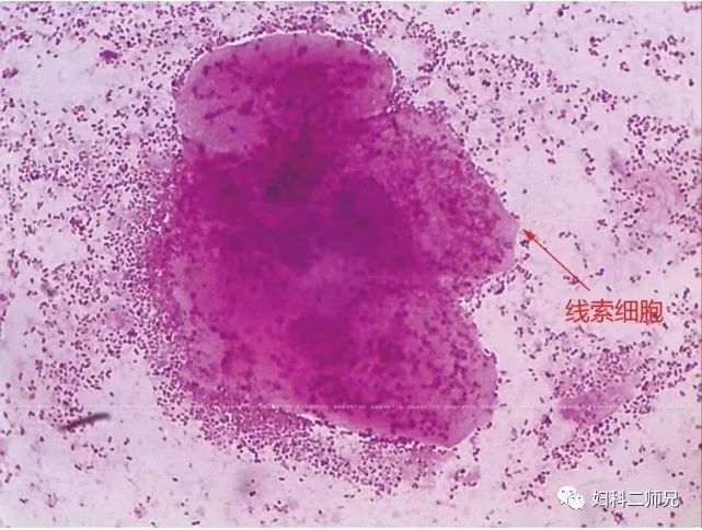 线索细胞即阴道脱落的表层细胞,于细胞边缘贴附颗粒状物即各种厌氧菌