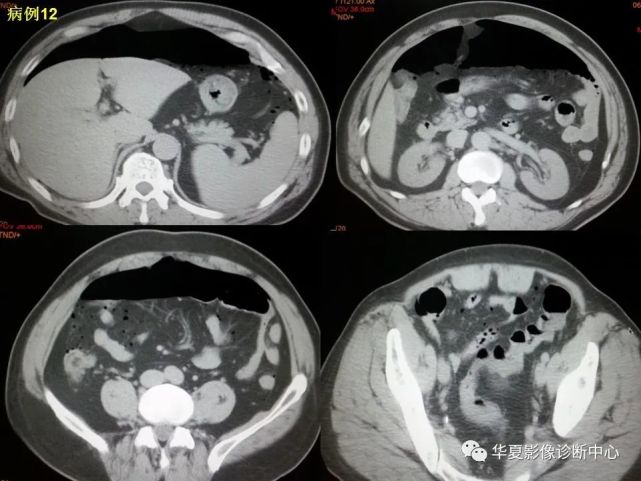 消化道穿孔ct影像大汇总,看完印象深刻!