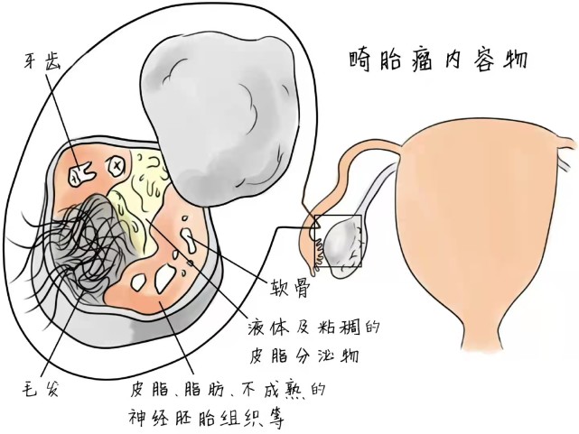 畸胎瘤不等于"怪胎",早发现早干预!