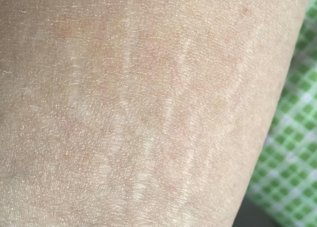 那肥胖纹就更好理解了,就是由于短时间内迅速地变胖,皮肤的生长速度