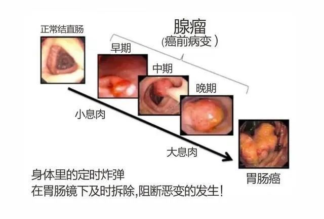 一人患肠息肉直系亲属肠癌风险增43