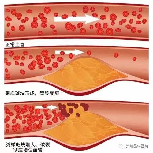 他叫王炳彦,是血管斑块消除技术专利发明人,他说高血压的成因与目前