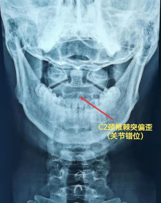 颈椎张口位片:主要是观察是否有齿状突先天畸形/不连,骨质破坏,寰齿