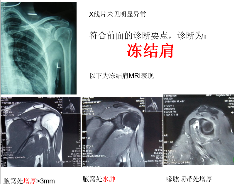 骨科精读从检查到治疗聊聊肩周炎那些事