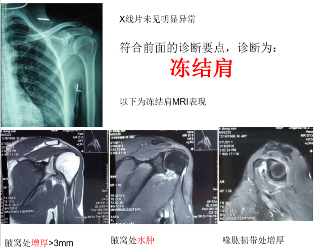 冻结肩的鉴别诊断:1"肩袖损伤"的典型表现:疼痛,力弱,静息痛,夜间痛.