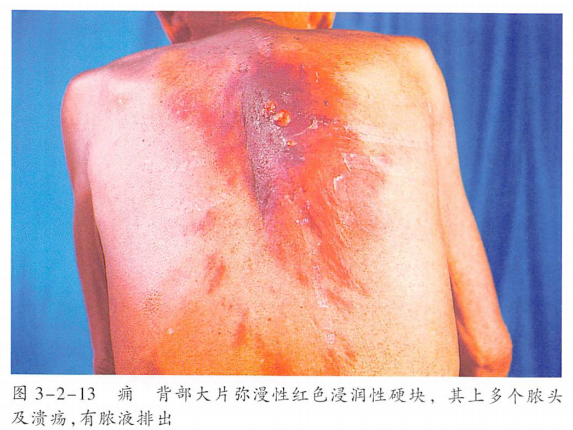 痈,则是多个邻近得毛囊发生深部感染引起的聚集性疖肿,可以理解为疖的